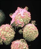 Imagen de una célula de leucemia